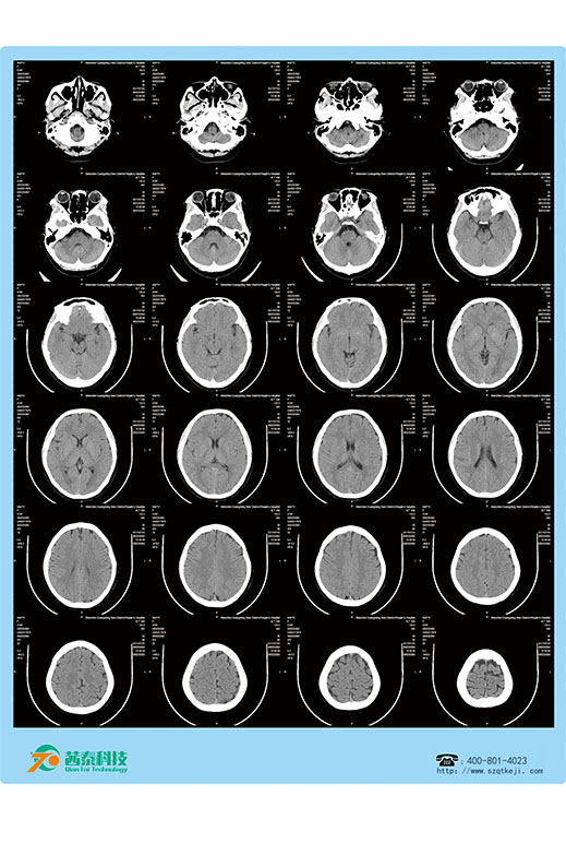热敏胶片-CT头颅.jpg