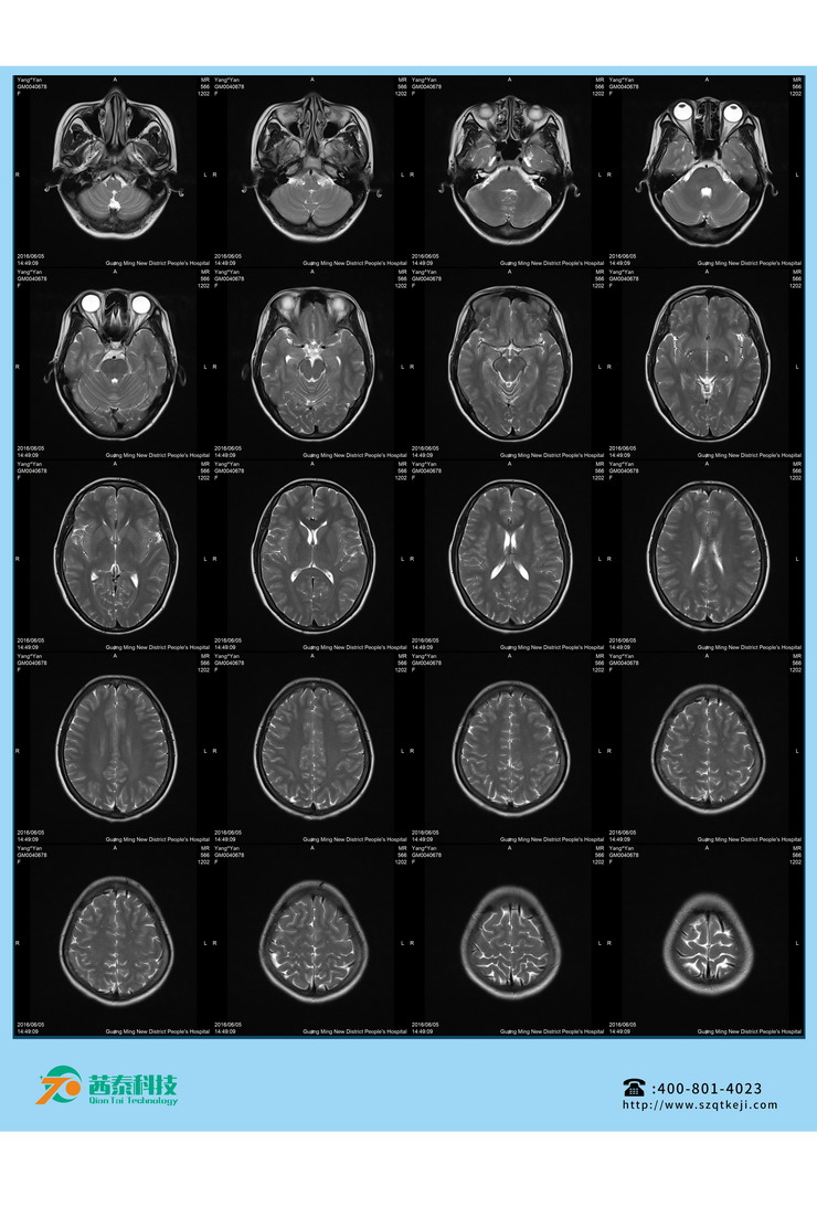 热敏胶片-MR头颅 (2).jpg