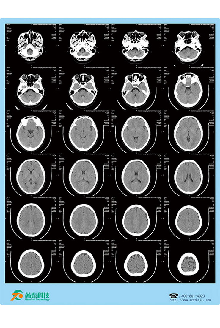 医用激光胶片-CT头颅.jpg